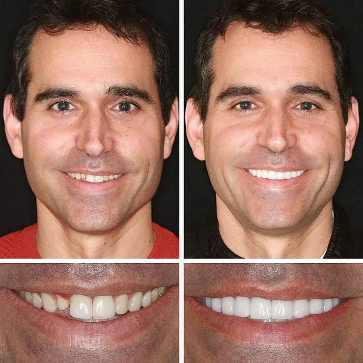 Ends Today: 49% OFF! ⏰ KLENIMORE™ Custom-Fit Smile Support Set — Strong Hold & Natural Look 🦷