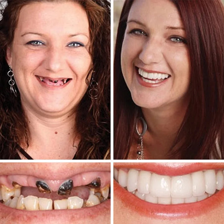 🏆Ends Today: 50% OFF! 🏆2026 Bestselling Product🦷 Fit for a Fresh Smile, Say Goodbye to Wearing Discomfort!🌎