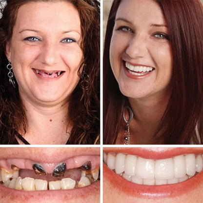 🏆Ends Today: 50% OFF! 🏆2026 Bestselling Product🦷 Fit for a Fresh Smile, Say Goodbye to Wearing Discomfort!🌎