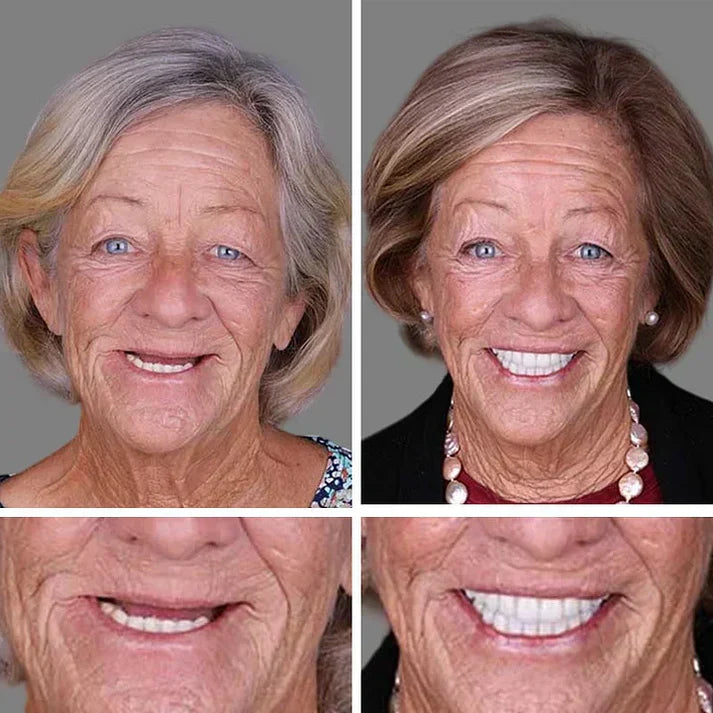 Ends Today: 49% OFF! ⏰ KLENIMORE™ Custom-Fit Smile Support Set — Strong Hold & Natural Look 🦷