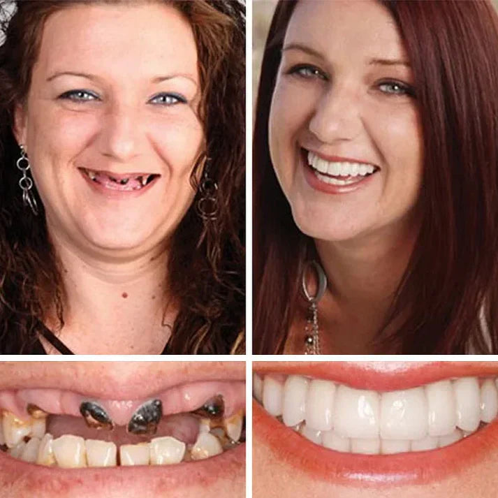 Ends Today: 49% OFF! ⏰ KLENIMORE™ Custom-Fit Smile Support Set — Strong Hold & Natural Look 🦷