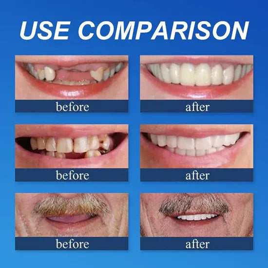 🏆Ends Today: 50% OFF! 🏆2026 Bestselling Product🦷 Fit for a Fresh Smile, Say Goodbye to Wearing Discomfort!🌎