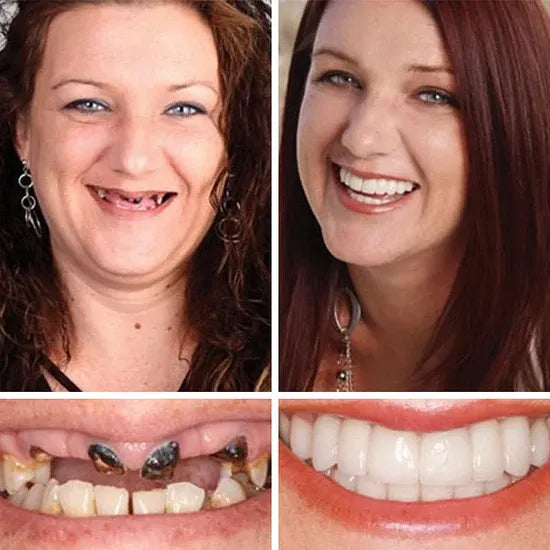 🏆Ends Today: 50% OFF! 🏆2026 Bestselling Product🦷 Fit for a Fresh Smile, Say Goodbye to Wearing Discomfort!🌎
