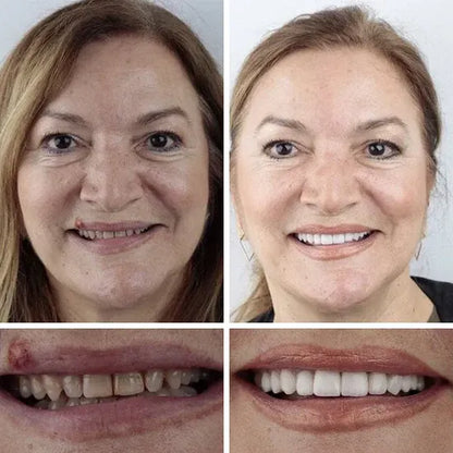 🏆Ends Today: 50% OFF! 🏆2026 Bestselling Product🦷 Fit for a Fresh Smile, Say Goodbye to Wearing Discomfort!🌎